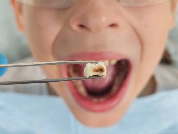 Best Emergency Wisdom Tooth Extraction in Palermo, CA